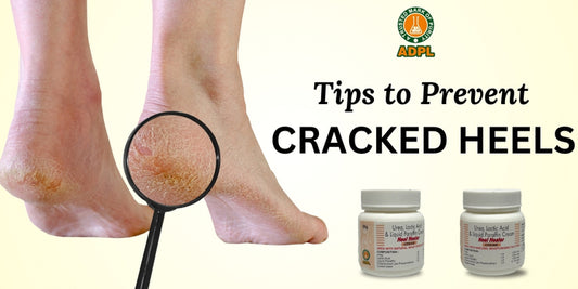 How to Prevent Cracked Heels: Say Goodbye to Rough, Painful Feet